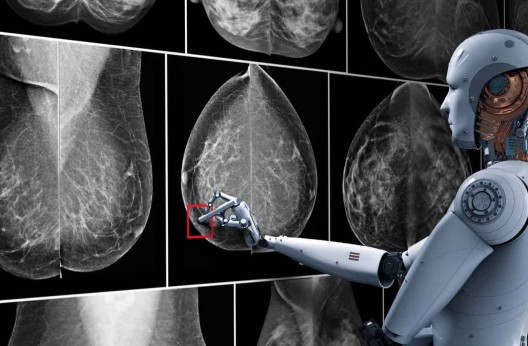 Cancer du sein : L’IA peut identifier les femmes à risque en amont